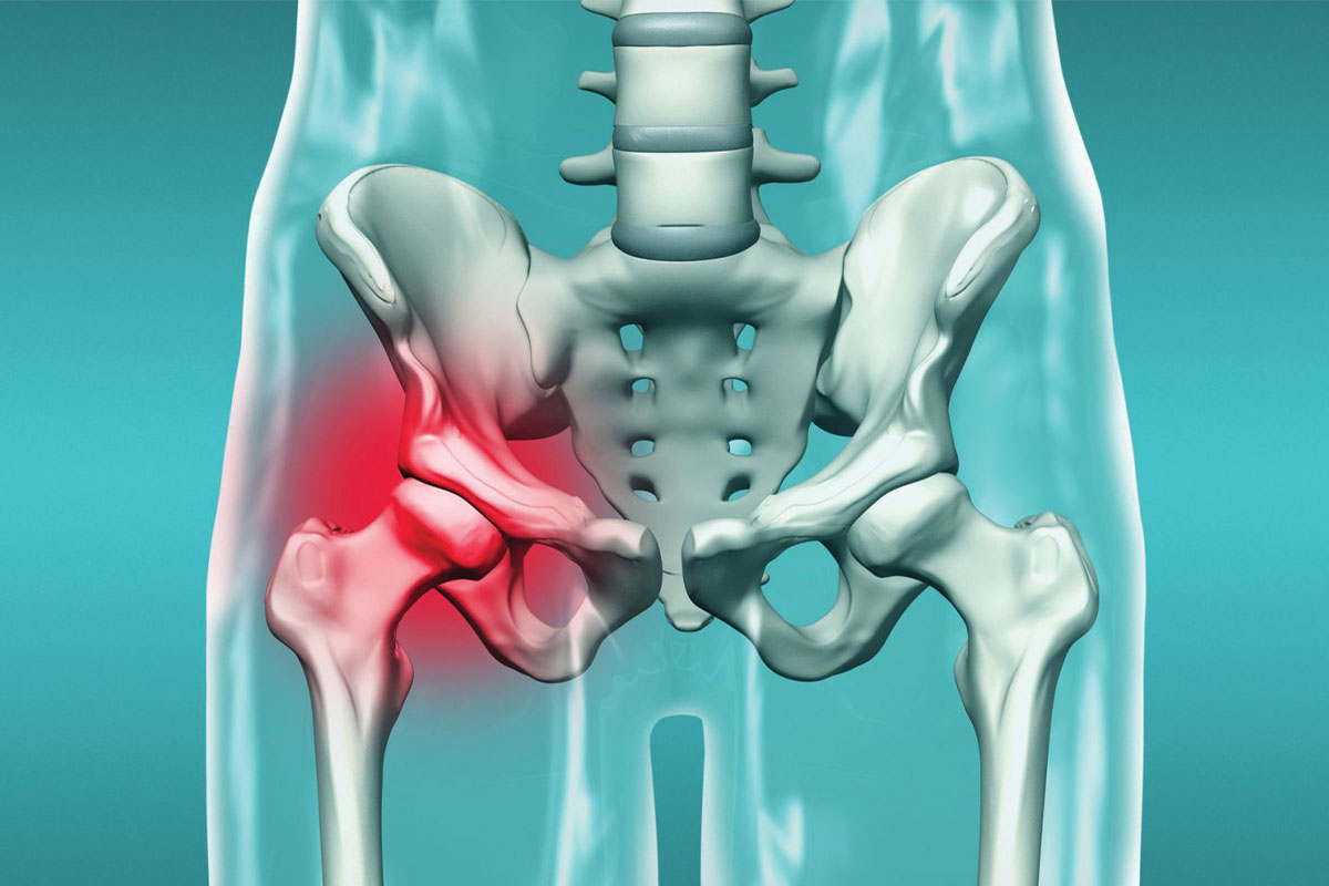 What is Hip Dislocation? What Are Its Symptoms?